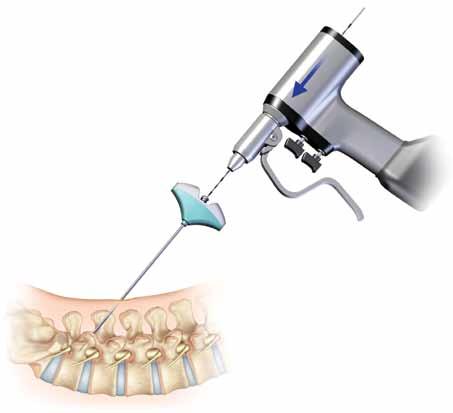 VIPER F2 Transfacet Pedicular System Surgical Technique Manual 9 Drilling and Placing Guidewire Insert a sharp tip guidewire into the Jamshidi needle and take a lateral fluoroscopy shot to visualize