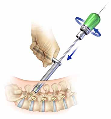 VIPER F2 Transfacet Pedicular System Surgical Technique Manual 18 VIPER F2 Screw Insertion Using the cannulated self-retaining screwdriver, guide the screw and polyaxial ring assembly over the