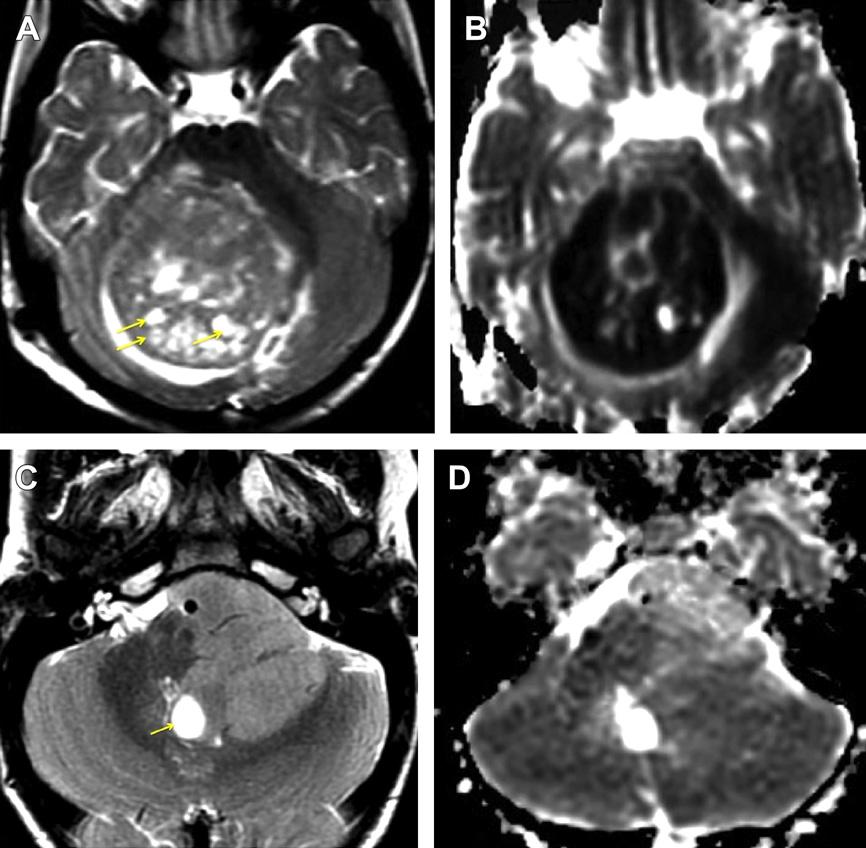Mass in the cerebellopontine angle is very characteristic of ependymomas (C). Restricted diffusion is classically seen in the medulloblastoma (B: ADC map) because of high cellularity.