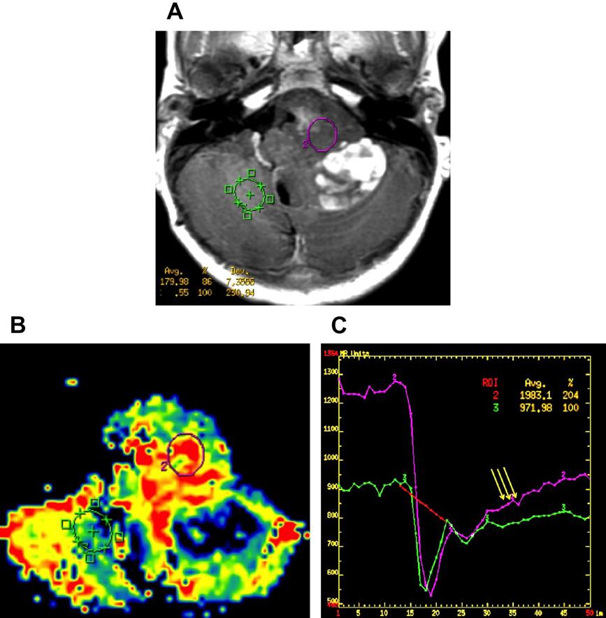 Multimodality Imaging of Brain Tumors 209 Fig. 11. Ependymoma versus medulloblastoma: dynamic susceptibility contrast (DSC) study.