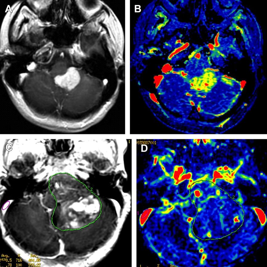 Multimodality Imaging of Brain Tumors 211 Fig. 13. Ependymoma: DCE study. (A, B) Ependymoma in an adult patient.