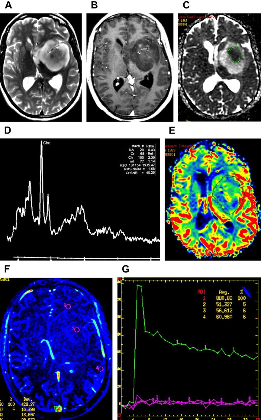 Multimodality Imaging of Brain Tumors 213 Fig. 15. Grade III glioma. A 41-year-old woman presenting with depression, headaches, and panic attacks.
