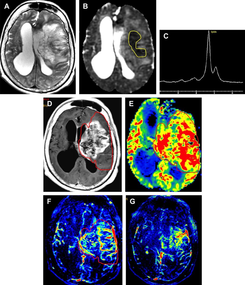 214 Brandão etal Fig. 16. Grade IV glioma. A 64-year-old woman found unconscious. There is a large heterogeneous lesion involving the left frontal and parietal lobes (A: axial T2).