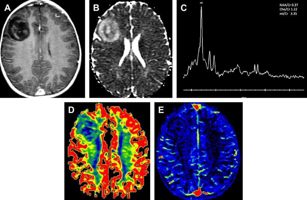 Multimodality Imaging of Brain Tumors 215 Fig. 17. Low-grade (grade II) astrocytoma. A 5-year-old boy who presented with 1 seizure episode at the age of 7 months.