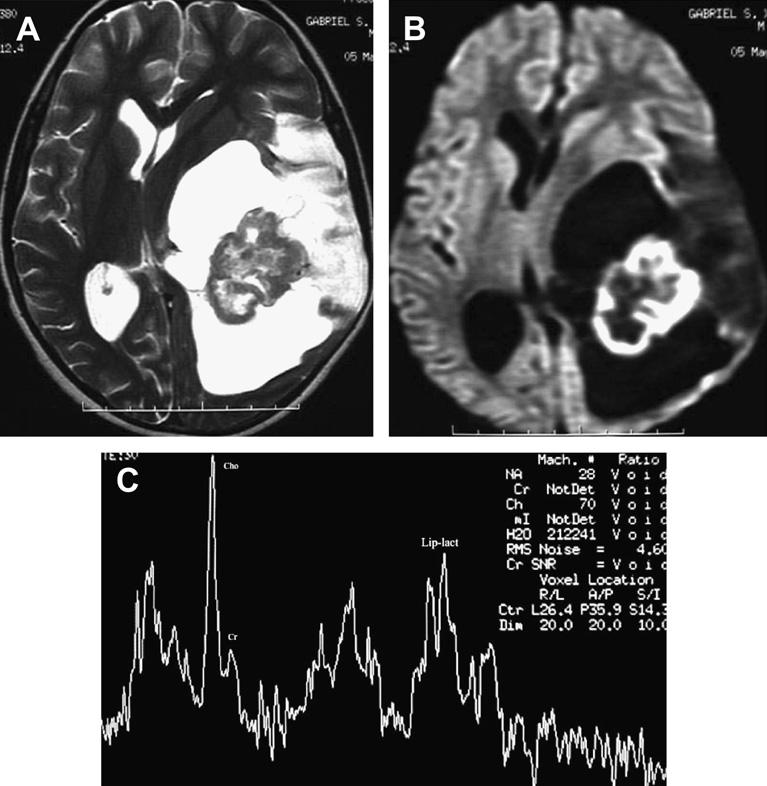 216 Brandão etal Fig. 18. Pilocytic astrocytoma (PA). A 9-year-old boy presenting with epilepsy and right-side hemiparesis.