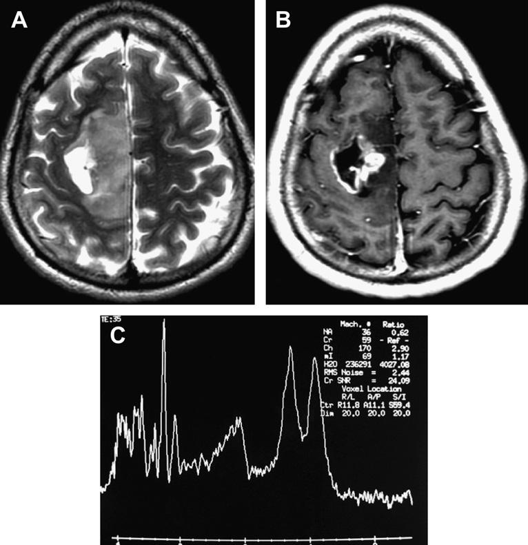 Multimodality Imaging of Brain Tumors 217 Fig. 20. Grade III glioma misdiagnosed as grade IV glioma. A 24-year-old man presenting with seizures.