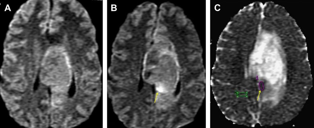 220 Brandão etal (Fig. 23). A calculated ADC ratio (tumoral ADC divided by the ADC in the contralateral white matter) of less than 1.0 is related to malignant transformation in LGGs.