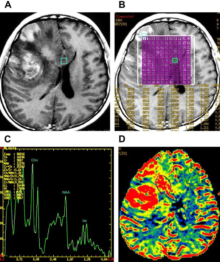 Multimodality Imaging of Brain Tumors 223 Fig. 26. Evaluation of tumor extension. A 48-year-old woman diagnosed with GBM.