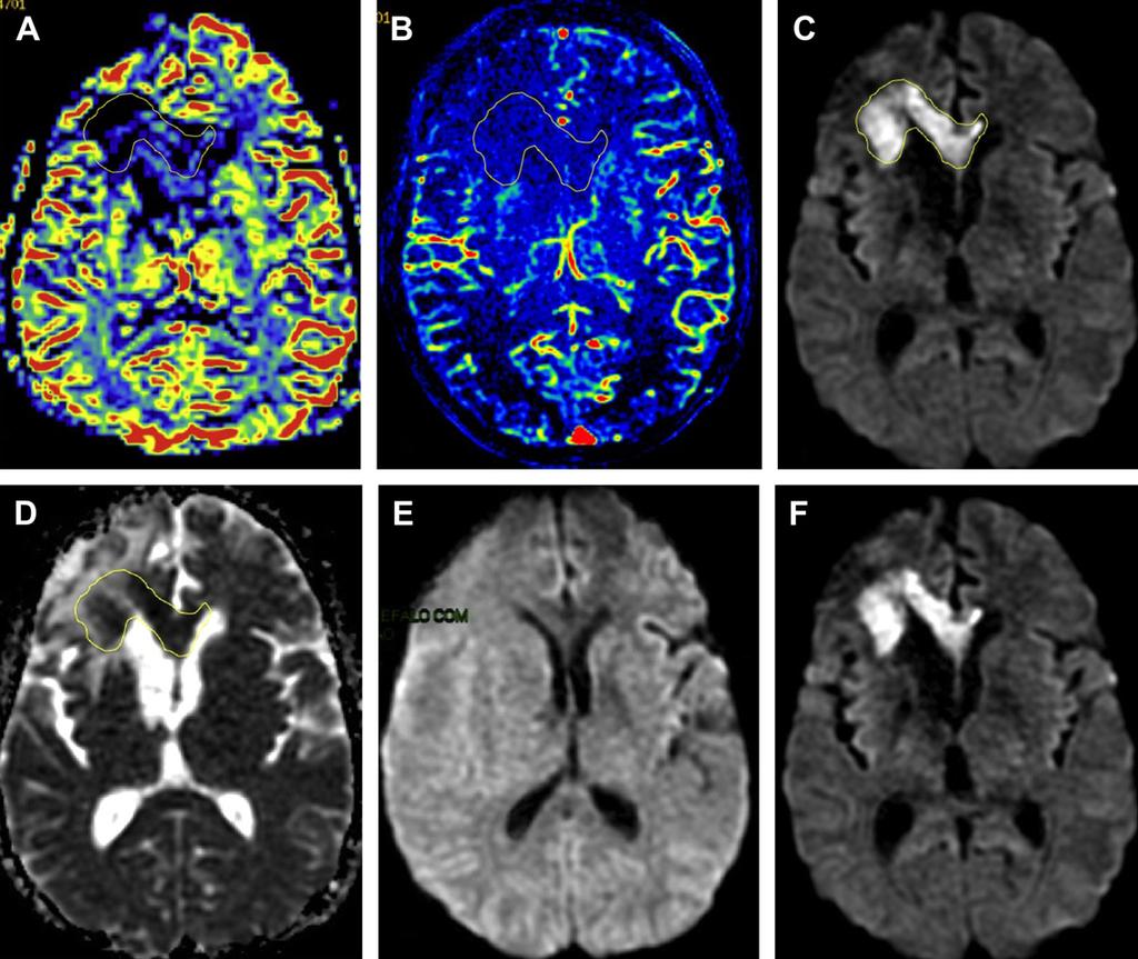 226 Brandão etal Fig. 28. Effects of antiangiogenic therapy. A 48-year-old woman diagnosed with right frontal GBM.
