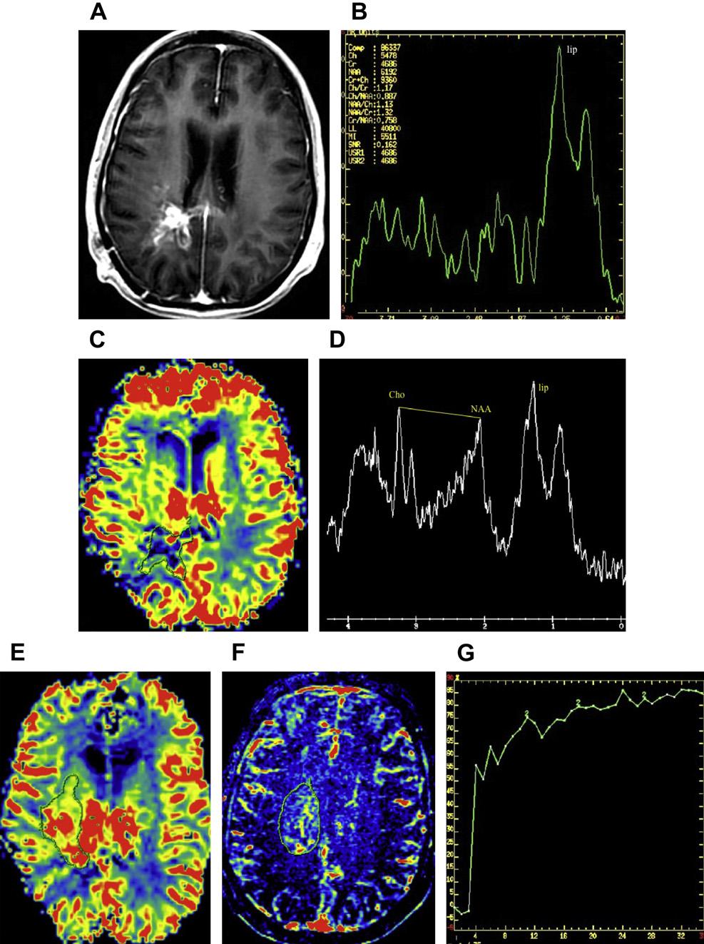 Multimodality Imaging of Brain Tumors 227 Fig. 29. Radiation necrosis versus tumor recurrence.