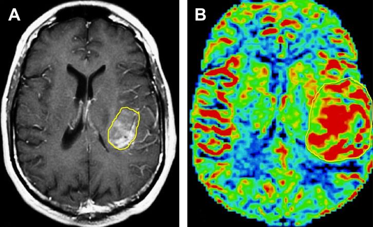 Multimodality Imaging of Brain Tumors 203 Fig. 3. Peritumoral relative cerebral blood volume (rcbv). A 67-year-old woman presenting with headaches.