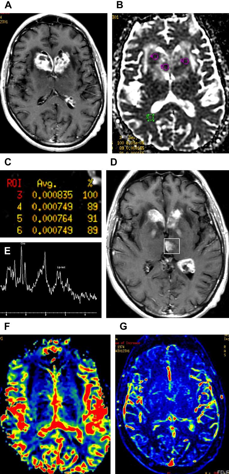 Multimodality Imaging of Brain Tumors 205 Fig. 6. GBM versus lymphoma.