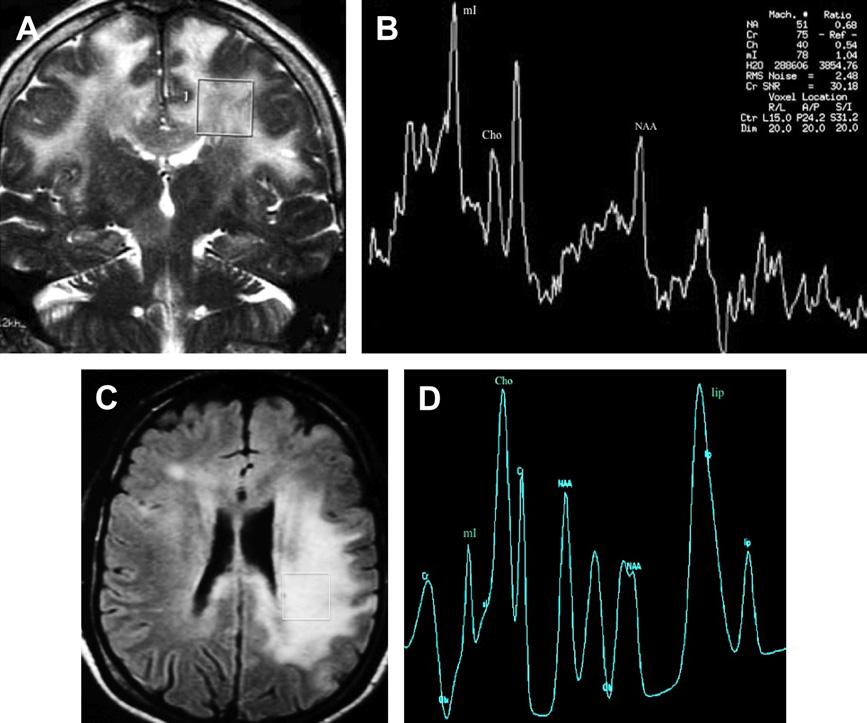 Multimodality Imaging of Brain Tumors 207 Fig. 8. Lymphomatosis versus gliomatosis cerebri. Gliomatosis cerebri infiltrating the white matter bilaterally (A: coronal T2).