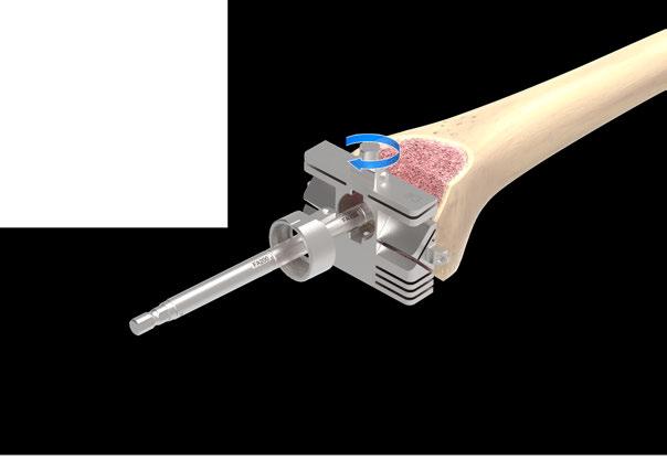 3.7 Offset Femoral Preparation 3.7.1 Offset Sizing and Placement 1. Access the proper ML size with the Femoral Cutting Guide over the Straight Stem Reamer and against the surface of distal femur. 2.