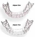 50 per aligner) $200 $160 and up $60 per tray (price includes resetting of teeth) Smart Moves offers seating and controlled movement, high predictability, and patient comfort.