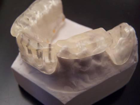 Partially edentulous: The CT Guide extends into the sulcus area, covers the occlusal and