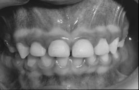 After the restorations MUST IMPROVE Oral Hygiene Feeding Behaviors Ensure