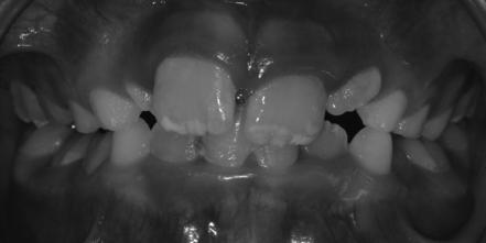 JB 8yo *Had infant formula from 6-12 months *1 st tooth erupted around 10 months old *Now seeing Fluorosis on