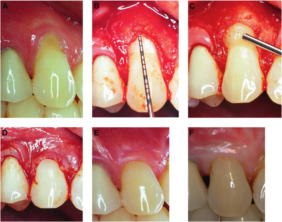 J Periodontol November 2012 McGuire, Scheyer, Nunn Figure 1. Patient 20. A) At baseline, a maxillary cuspid randomized to receive test (EMD) treatment.