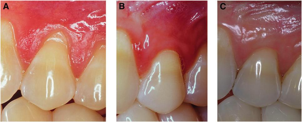 A) At baseline, the contralateral bicuspid randomized to receive test (EMD) treatment. B) A 12-month follow-up with no recession and 2 mm of wkt.