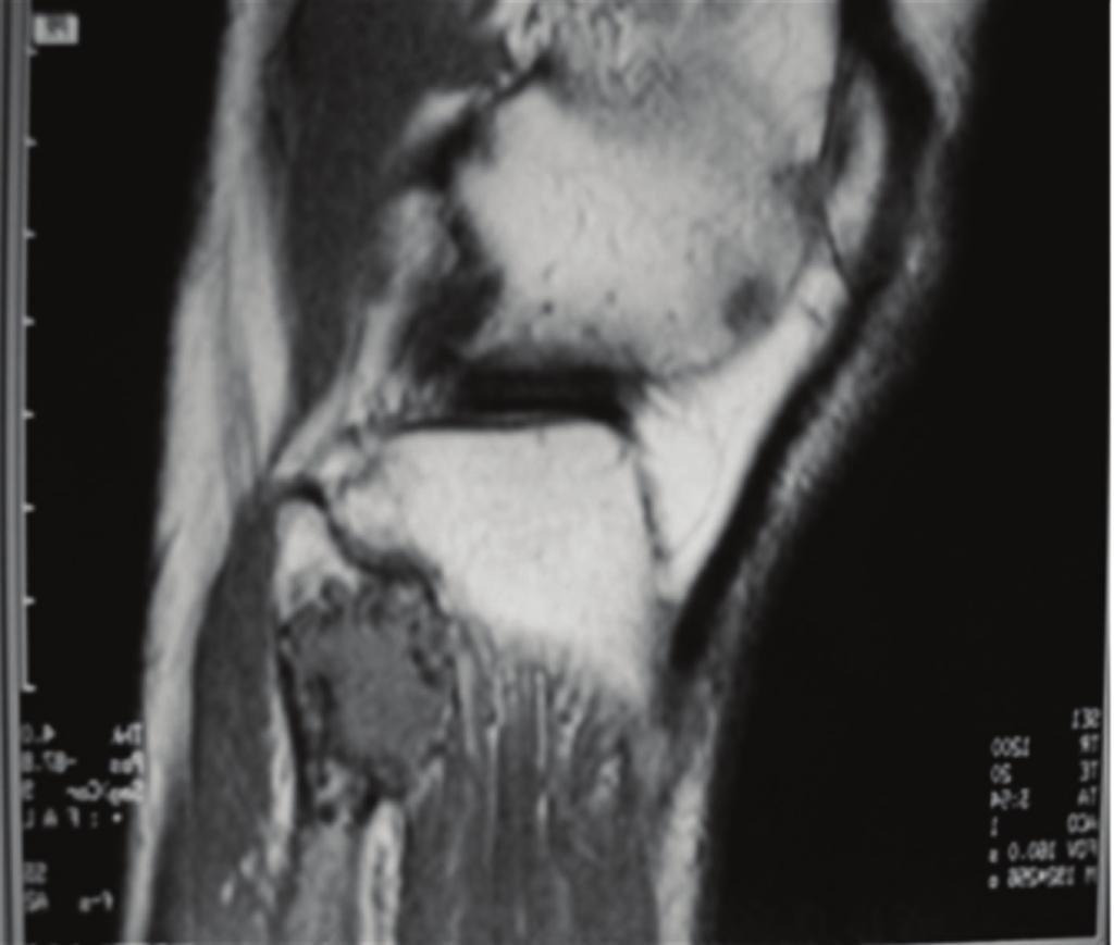 Figure 4: MRI of the same lesion showing cortical damage and soft tissue mass. but E was more common in diaphysis.