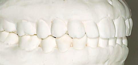 aligner, using chairside reactivation if necessary.