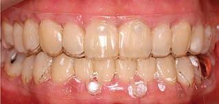 malocclusion and deep bite before treatment.