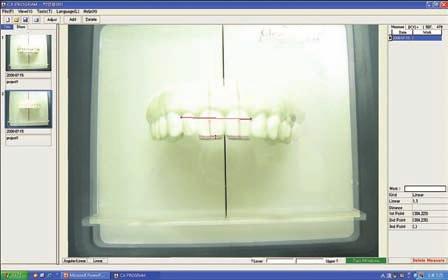 10), the Clear ligner Program (CP) was used to superimpose digital photographs of the pre- and post-treatment casts. The program can measure tooth movements in.