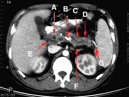 Chronic Pancreatitis Common features of CP A) Pseudocysts B) Calcifications C) Dilated duct D) Pancreatic atrophy E) BD stenosis-dilation F) Splenic vein thrombosis G) Gastric varices www.pancreas.