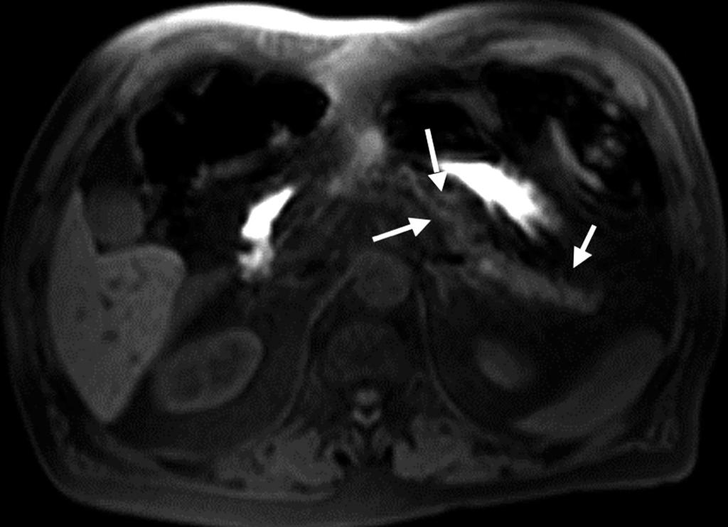 c Figure 2. a c. MRI of a patient with chronic pancreatitis. The T1-weighted fatsuppressed image shows an atrophic pancreas with diminished signal (arrows, a).