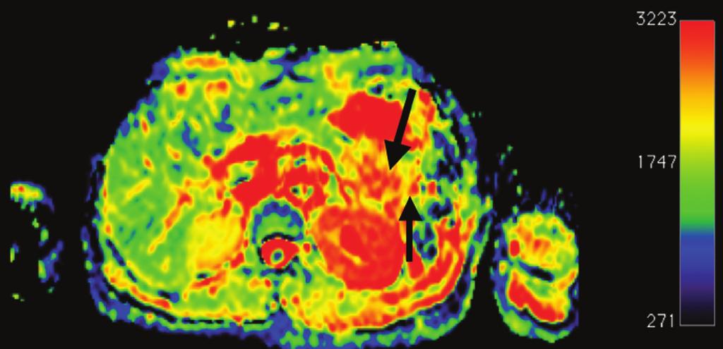 Figure 4. a,. Colored ADC map derived from diffusion-weighted MRI (DWI) of the pancreas. A normal pancreas with associated ADC values and colors is shown (arrows, a).