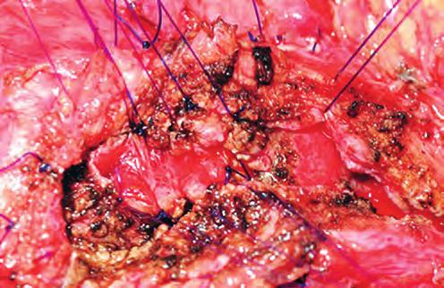 a Gallbladder b c Stomach Pancreas Duodenum Superior mesenteric artery Superior mesenteric vein Figure 8 Surgical management of chronic pancreatitis. a Duodenum-preserving pancreatic head resection.
