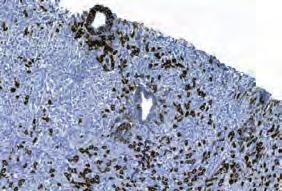 f Granulocytic epithelial lesions of an interlobular medium-sized duct with a ruptured epithelium (arrow) in autoimmune pancreatitis type 2.