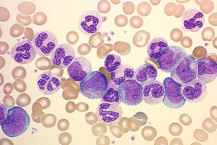 Chronic Myeloid Leukemia Splenomegaly CML (3 phase disease)