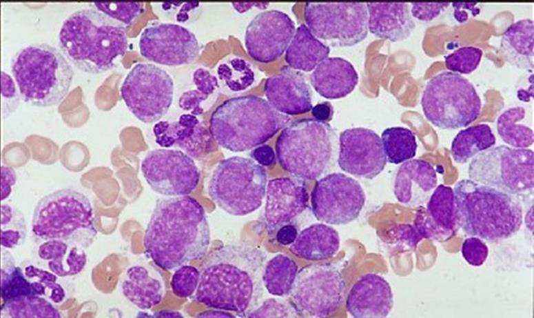 CML laboratory Elevated WCC, myeloid series, left shift, often platelets high, Bone marrow myeloid