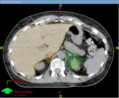 BR001 Benchmark Case: Bilateral Adrenal Metastases Metastases Overlap with Parallel Organs RT GTV & PTV: Overlap with liver LT GTV & PTV