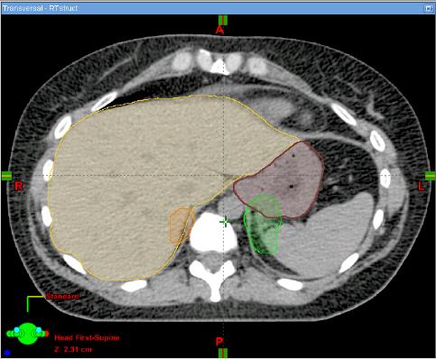 BR001 Benchmark Case: Bilateral Adrenal Metastases Metastasis Overlap with Serial Organ LT GTV & PTV: Overlap with