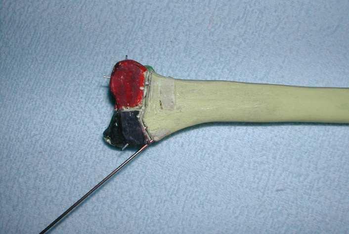 Provisional reduction of intra-articular articular fragments