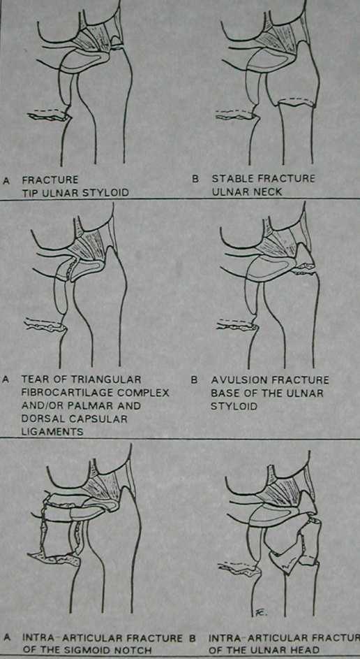 Managements of associated DRUJ lesions The Fernandez classification Type Ⅰ stable A+B early pronation-supination excercises. Type Ⅱ unstable A closed treatment.