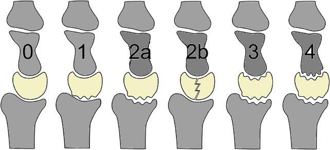 Bain cartilage/arthroscopic classification