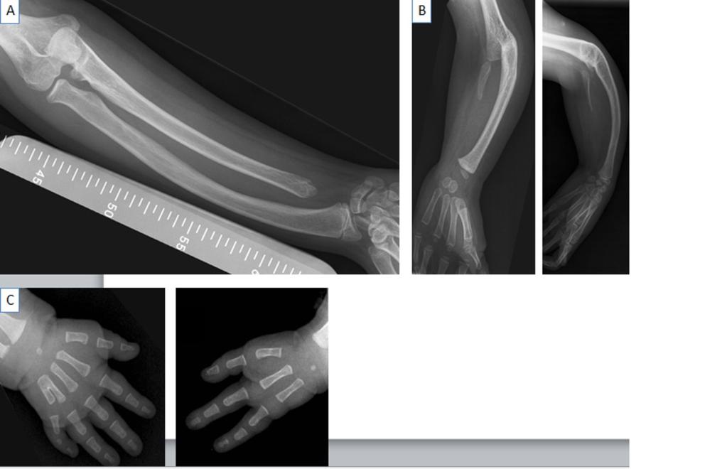 Fig. 4: A: Absence of distal ulna and radial bowing.