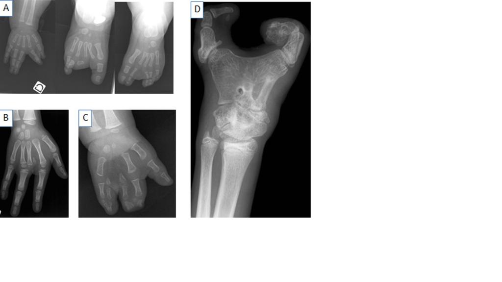 C: IV-V metacarpal synostosis on the right side and