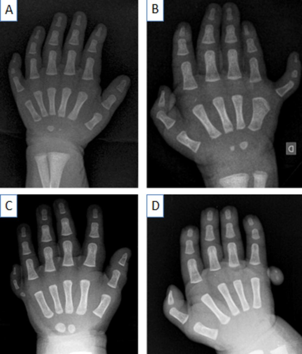 Fig. 11: A and B : Type A postaxial polydactyly.