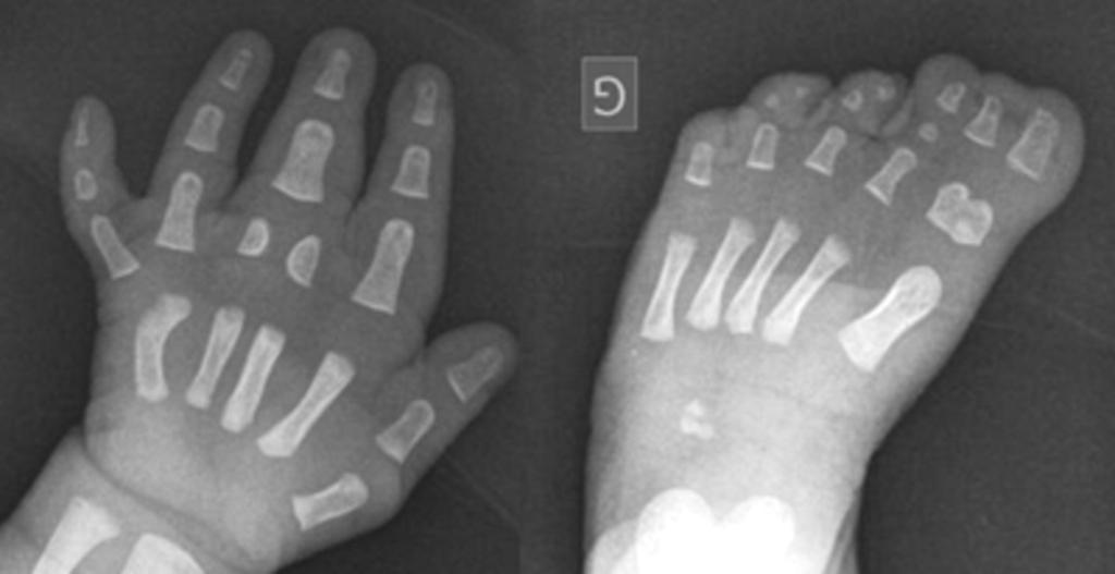Fig. 12: Polysyndactyly: postaxial polydactyly of the hand