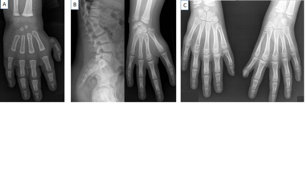 Fig. 3: A: Hypoplasia of thumb with strong shortening of the first metacarpal.the carpal bone deficit cannot be evaluated because of the patient's age (< 5 years old).
