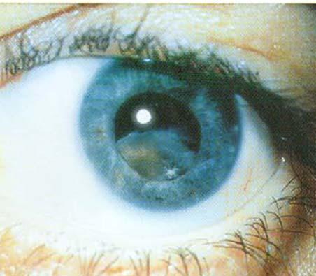 Symptoms of traumatic lens subluxation Fluctuation of vision Impaired accommodation Monocular diplopia[edge crosses the