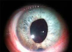 drop in AC[globular lens] It is difficult to see a clear