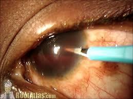 Hyphaema Hemorrhage can occur during lens removal and further interfere with visualization Paracentesis is done Use of