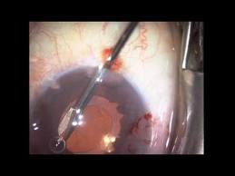 Synechiae During the acute phase of ocular trauma, fibrin rapidly forms membranes on the iris that can cause synechiae, pupil seclusion, and distortion of intraocular structures.