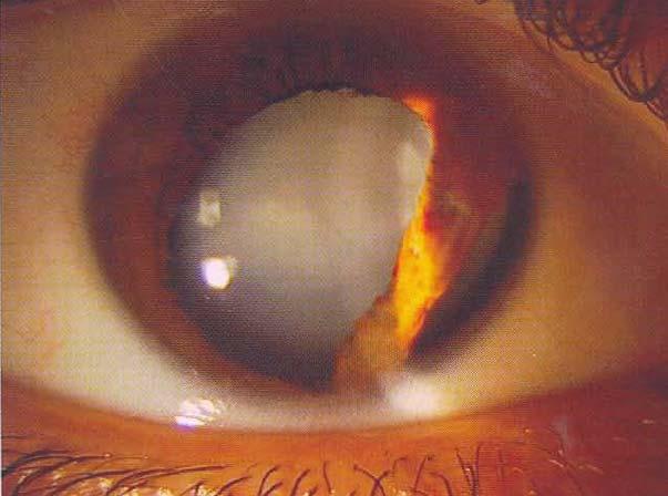 Iris Iridodialysis Sphincter ruptures needs repair when clinically significant pupillary